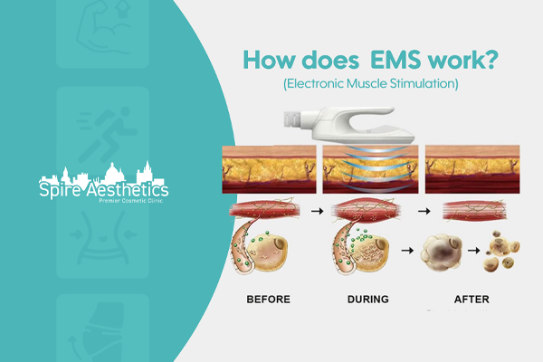 EMS treatment for post pregnancy weight loss treatment Richmond upon Thames