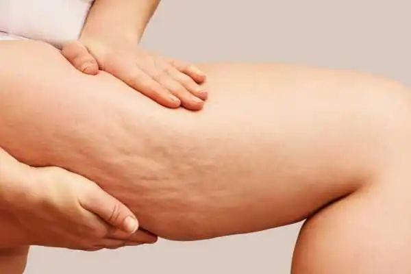 Image of woman showing leg with cellulite Richmond upon Thames