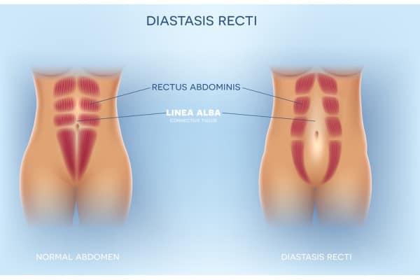 What Non-Surgical Options Are Available for Diastasis Recti Richmond upon Thames?