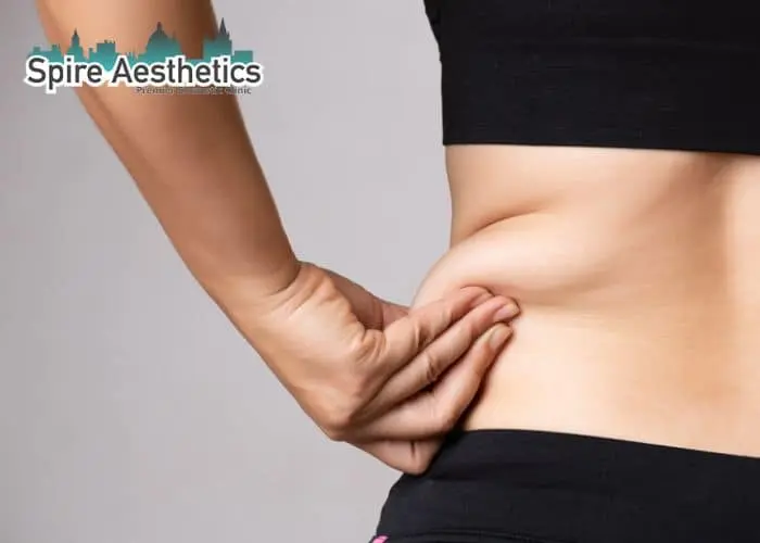 Image of woman pinching fat on their hips Richmond upon Thames. Fat Freezing treatment