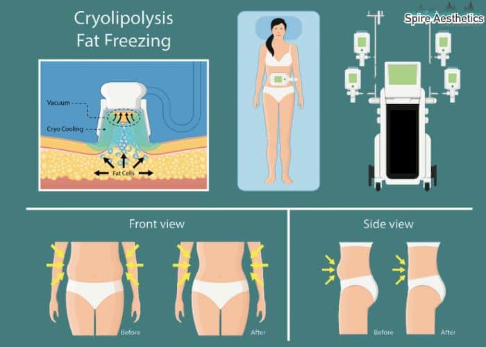 Image of diet and fat freezing combined for best results for Spire Aesthetics Richmond upon Thames