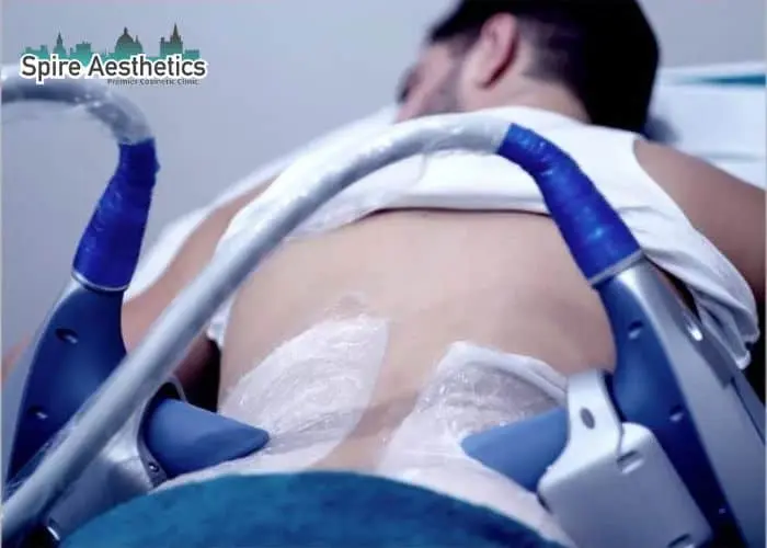 Man having fat freezing treatment done on love handles before a competitions Richmond upon Thames to create a sculpted look.