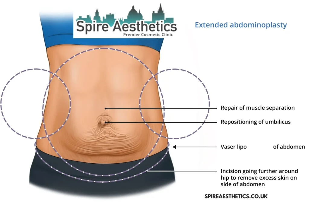 Understanding Loose Skin After Gastric Band Richmond upon Thames Surgery and HIFU Treatment