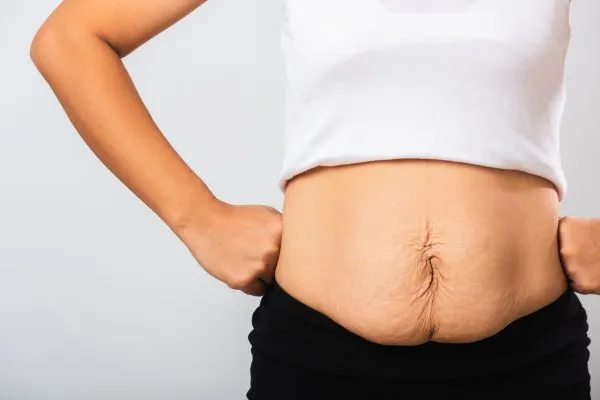 Image of a woman's stomach after weight loss with sagging skin following a gastric band Richmond upon Thames