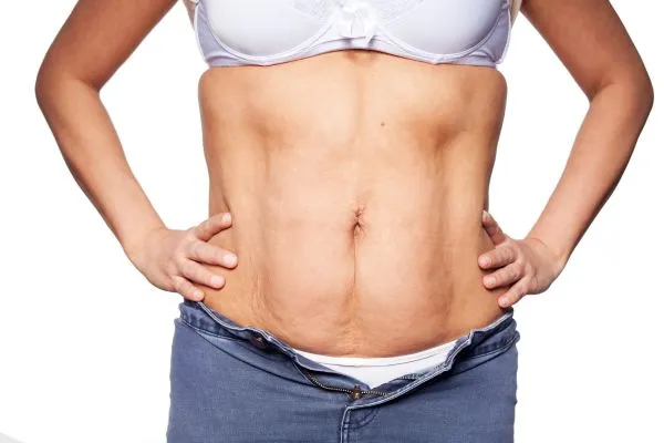sagging skin on woman's stomach after weight loss injections Richmond upon Thames