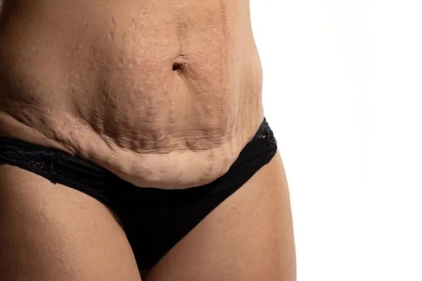 Image of womans stomach after weight loss injections Richmond upon Thames showing saggy skin