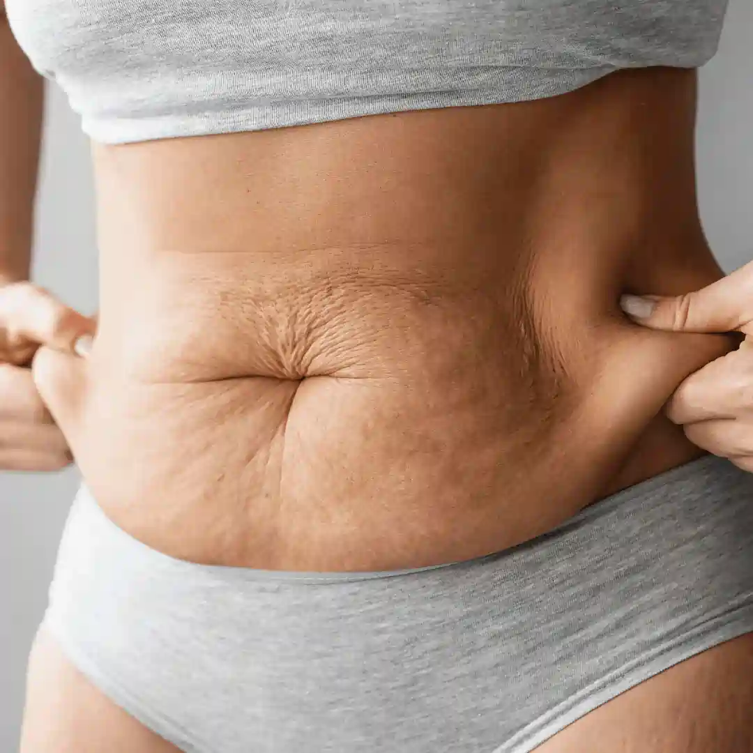 Is It Normal to Have Loose Skin After Pregnancy Richmond upon Thames?