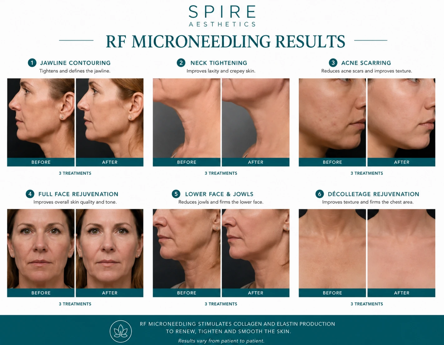 RF Microneedling Skin tightening Richmond upon Thames results