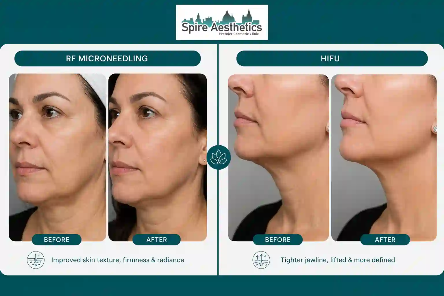 Can RF Microneedling and HIFU Be Combined Richmond upon Thames?