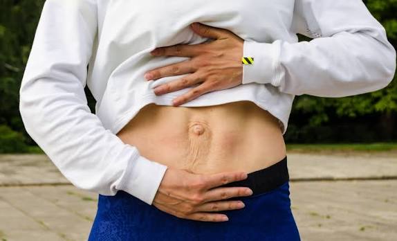 When Could Diastasis Recti Be the Missing Piece of the Puzzle Richmond upon Thames?