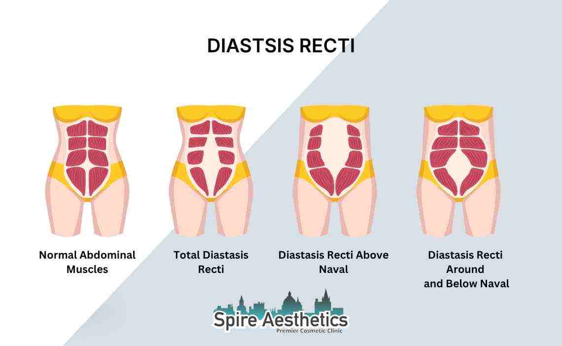 Is Non-Surgical Diastasis Recti Treatment Right for You? Common Concerns Answered Richmond upon Thames